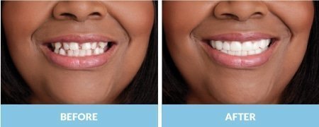 snap-on-smile4-1-1.jpg
