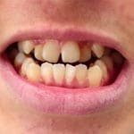 snap-on-smile-5-1-2.jpg