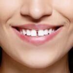 snap-on-smile-6-1-2.jpg